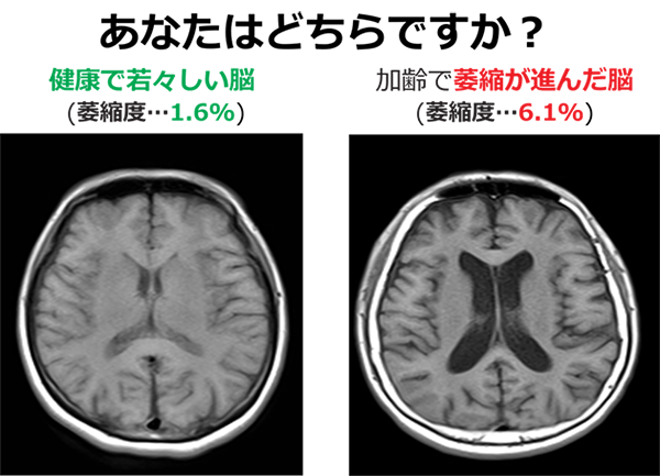 認知症はなぜ起こる？